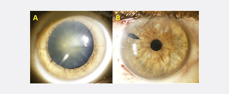 Queratotomía radial y LASIK: Un desafío en la cirugía de catarata con una sorpresa refractiva